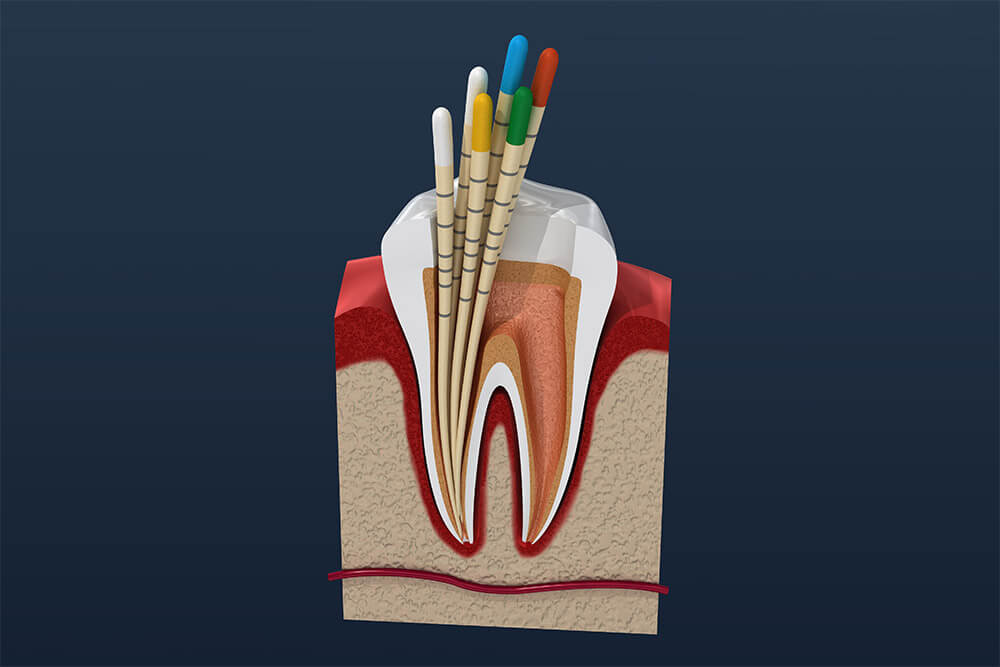 What are the Signs a Root Canal is Needed? Capital Dental